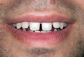 Teeth Whitening in Annadale