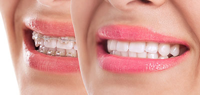 Rossi   DiLeo Dentistry, PC | Teeth Whitening, Dental Fillings and Sports Mouthguards