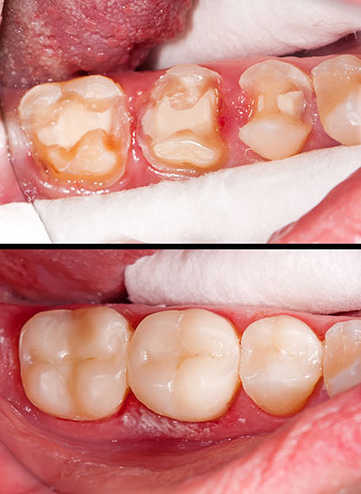 Rossi   DiLeo Dentistry, PC | Dentures, Night Guards and Emergency Treatment