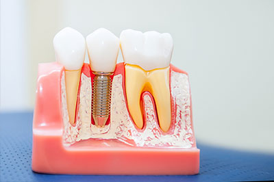 Rossi   DiLeo Dentistry, PC | All-on-4 reg , Teeth Whitening and Botox reg 