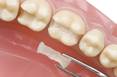 Rossi   DiLeo Dentistry, PC | Ceramic Crowns, Sports Mouthguards and Root Canals