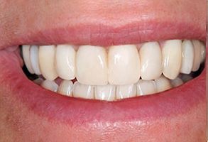 Rossi   DiLeo Dentistry, PC | Intraoral Camera, Oral Cancer Screening and Juvederm reg 