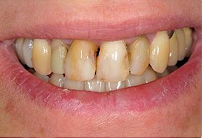 Rossi   DiLeo Dentistry, PC | All-on-6 reg , Sports Mouthguards and Dental Fillings